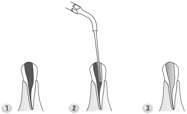 Сфера применения наконечника для скалера